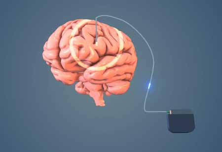 Exploring Vagus Nerve Stimulation: A Breakthrough in Neurological Treatment Exploring Vagus Nerve Stimulation: A Breakthrough in Neurological Treatment