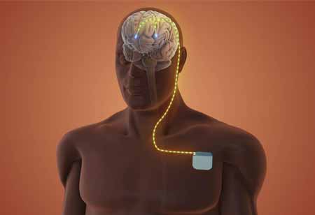 Emerging Opportunities in Nervous System Regulation Devices Emerging Opportunities in Nervous System Regulation Devices